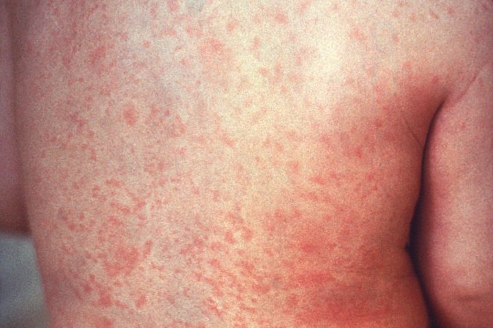measles