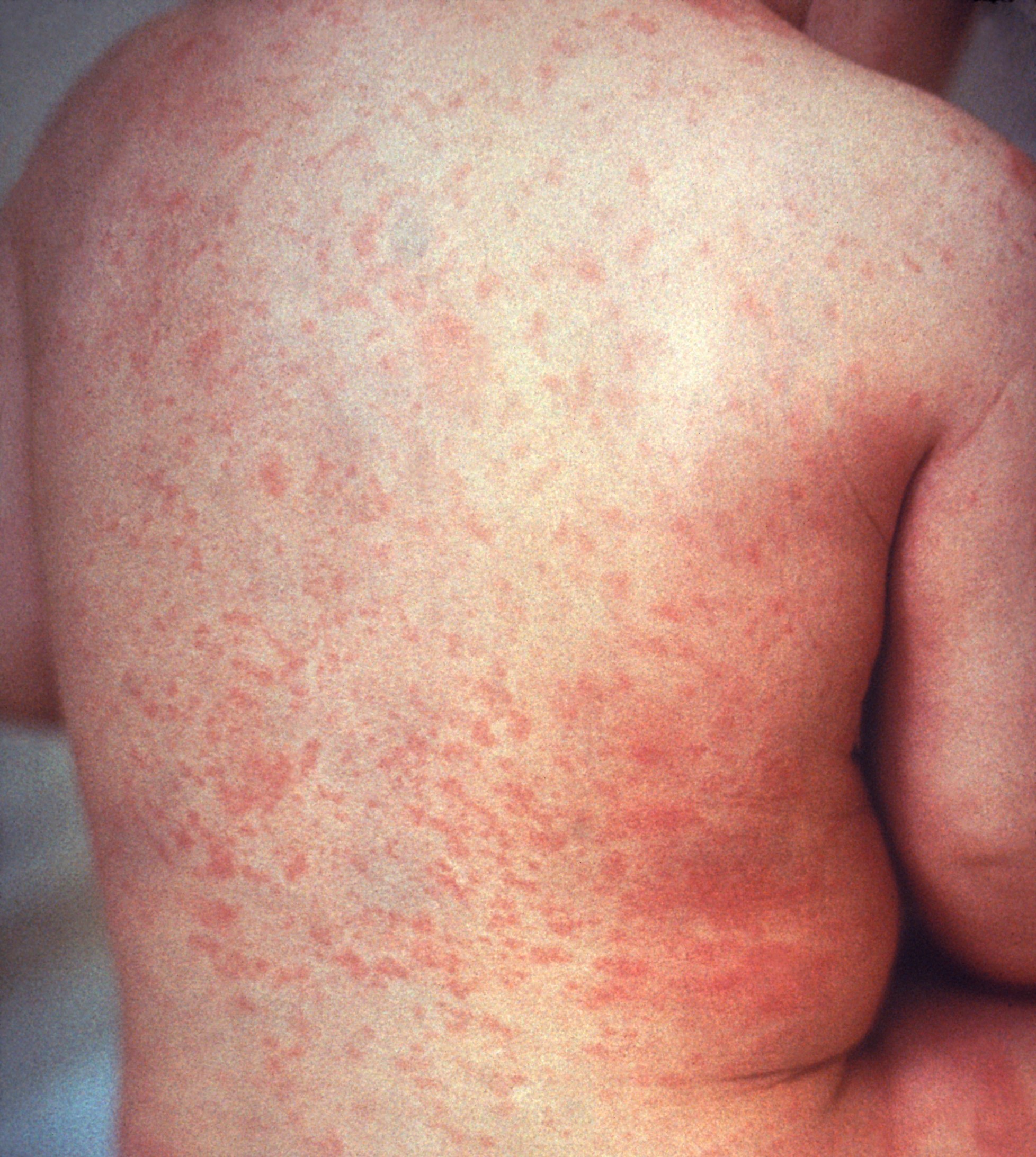 measles